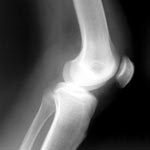 Knee Treatments | Rozelle Osteopaths