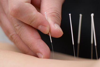 Treatment by acupuncture | Rozelle Osteopaths